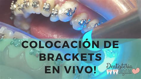 colocacion de brackets metalicos|Colocación de Brackets metálicos EN VIVO .